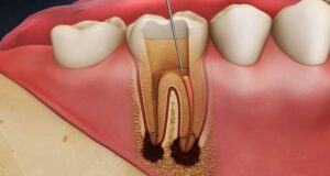 Bệnh lý thường gặp ở tuỷ răng
