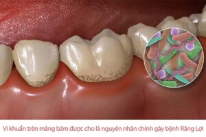 Những loại vi khuẩn gây bệnh răng lợi