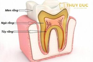 Điều trị viêm tuỷ răng