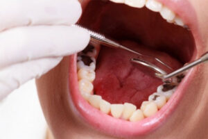 Bệnh về răng miệng