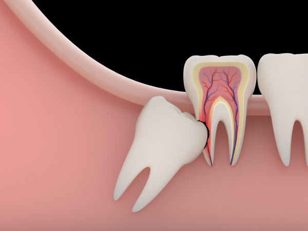 9 tác hại cực xấu do mọc răng khôn để lại mà bạn không thể bỏ qua