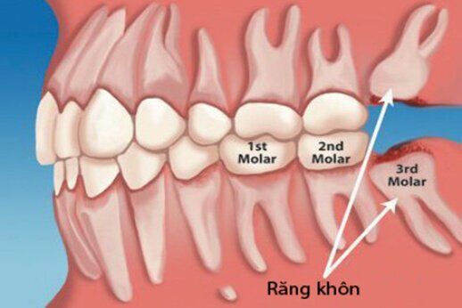 Tất tần tật về răng khôn Triệu chứng, cách chăm sóc và phương pháp nhổ răng khôn