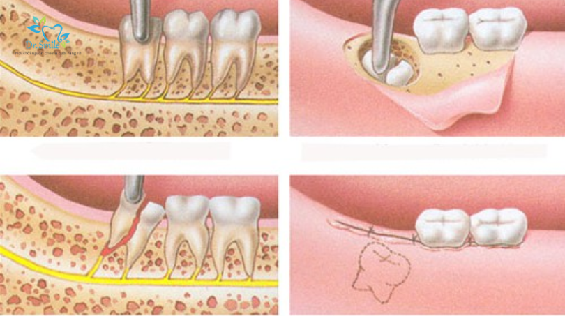 Tất tần tật về răng khôn Triệu chứng, cách chăm sóc và phương pháp nhổ răng khôn