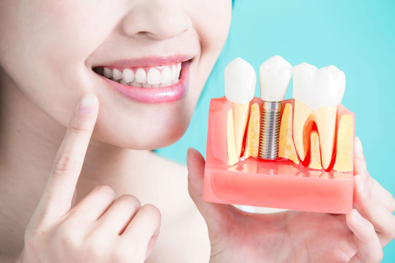 Tại Sao Cần Phải Trồng Răng Implant?